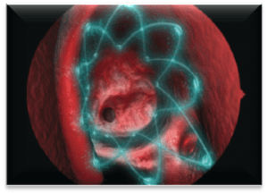 propel-sinus-stent-1