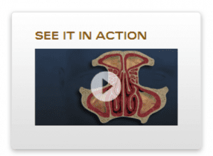 propel-sinus-stent-video